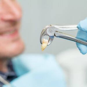 Dentist has extracted a sick tooth from patient in dental office Cerrahi Diş Çekimi