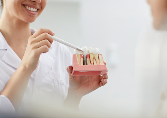Dental İmplant