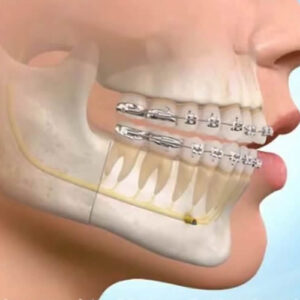 implant-tedavisi-yuz-estetigi Cerrahi Destekli Ortodontik Tedaviler