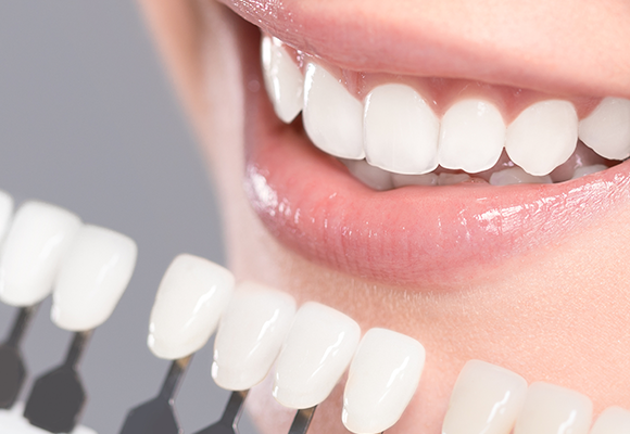 Laminate Restorasyonlar